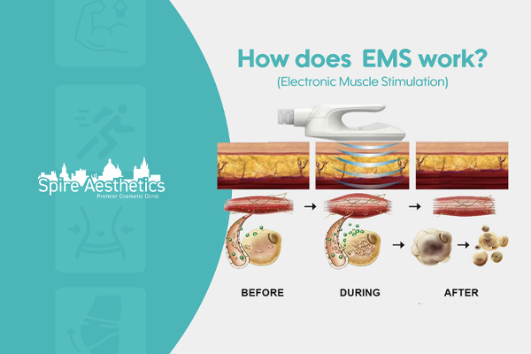 EMS treatment for post pregnancy weight loss treatment Cannock