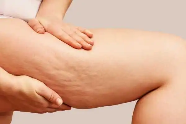 Image of woman showing leg with cellulite Cannock