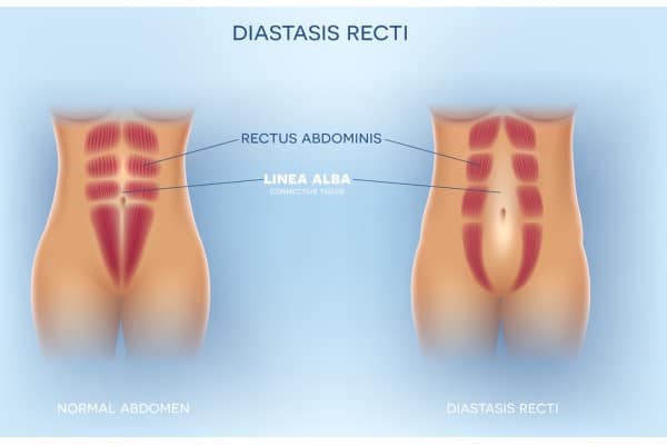 What Non-Surgical Options Are Available for Diastasis Recti Cannock?