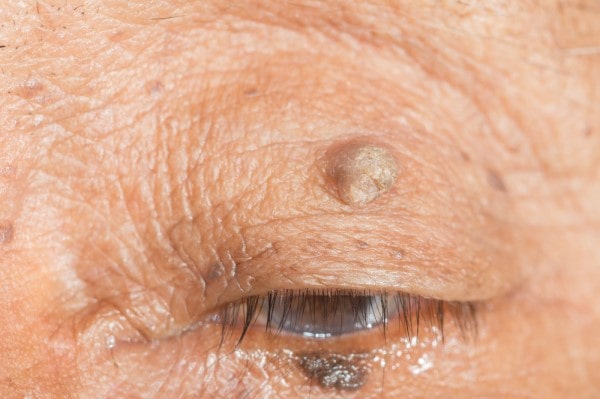 Skin imperfections Cannock - Cryopen is fast and effective book in today!