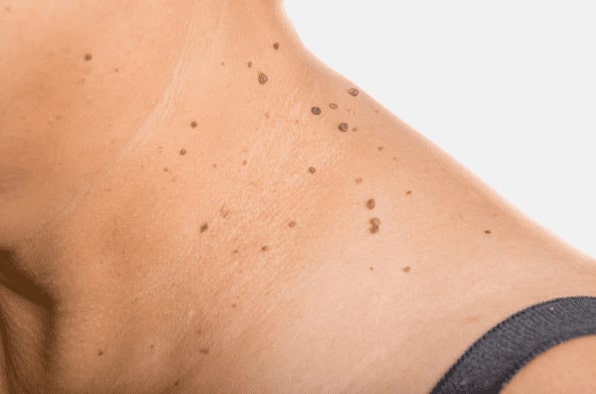 Are you looking for easy skin tag removal Cannock - then contact Spire today!