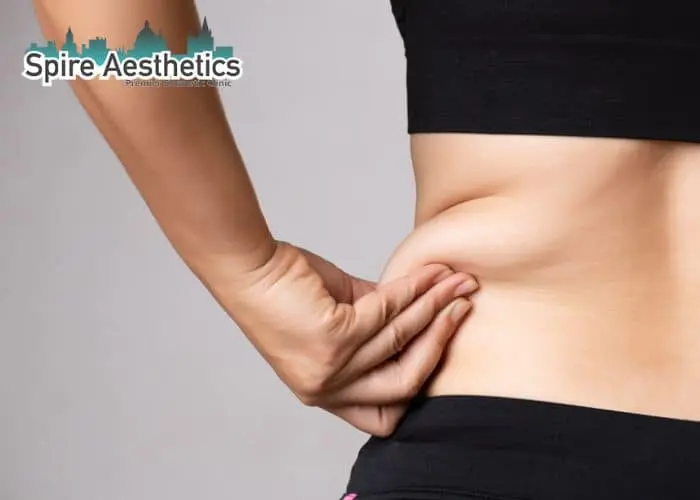 Image of woman pinching fat on their hips Cannock. Fat Freezing treatment