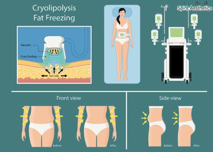 Image of diet and fat freezing combined for best results for Spire Aesthetics Cannock