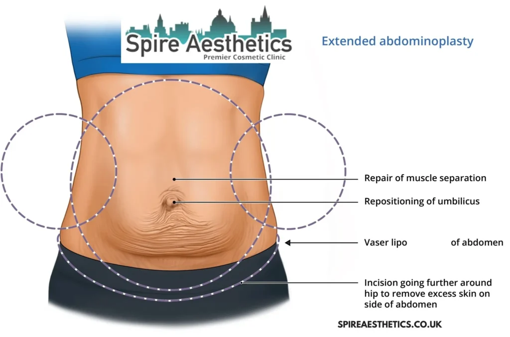 Understanding Loose Skin After Gastric Band Cannock Surgery and HIFU Treatment