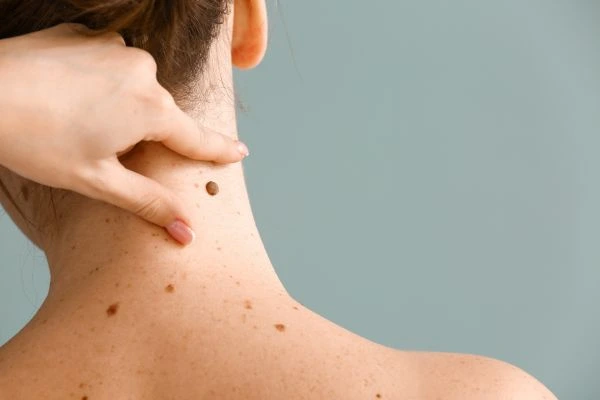 skin blemish removal Cannock treatment