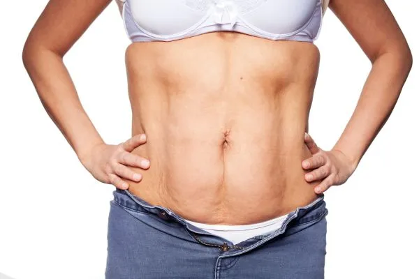 sagging skin on woman's stomach after weight loss injections Cannock