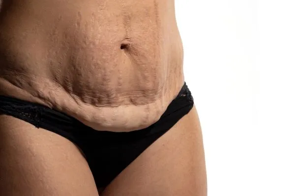 Image of womans stomach after weight loss injections Cannock showing saggy skin