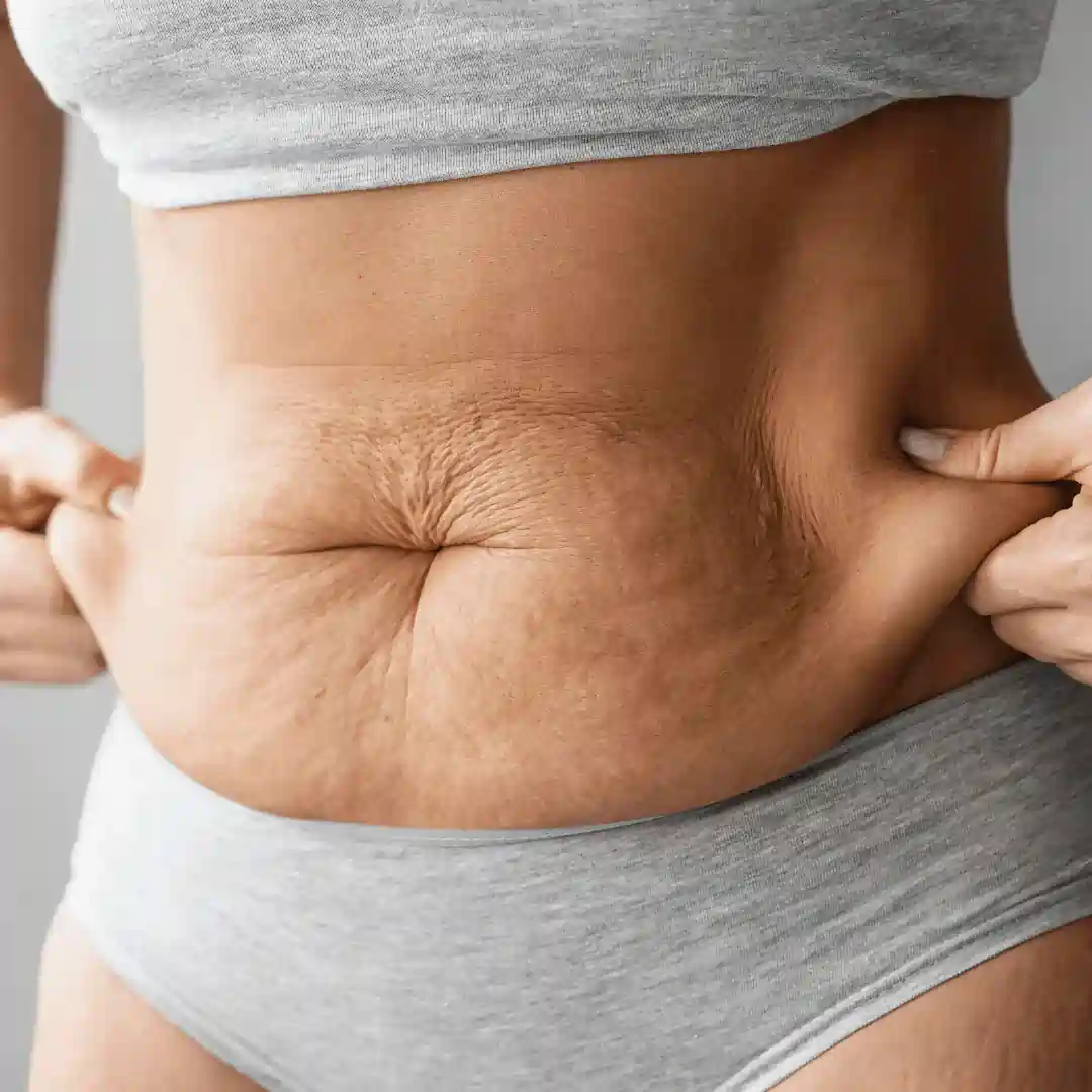 Is It Normal to Have Loose Skin After Pregnancy Cannock?