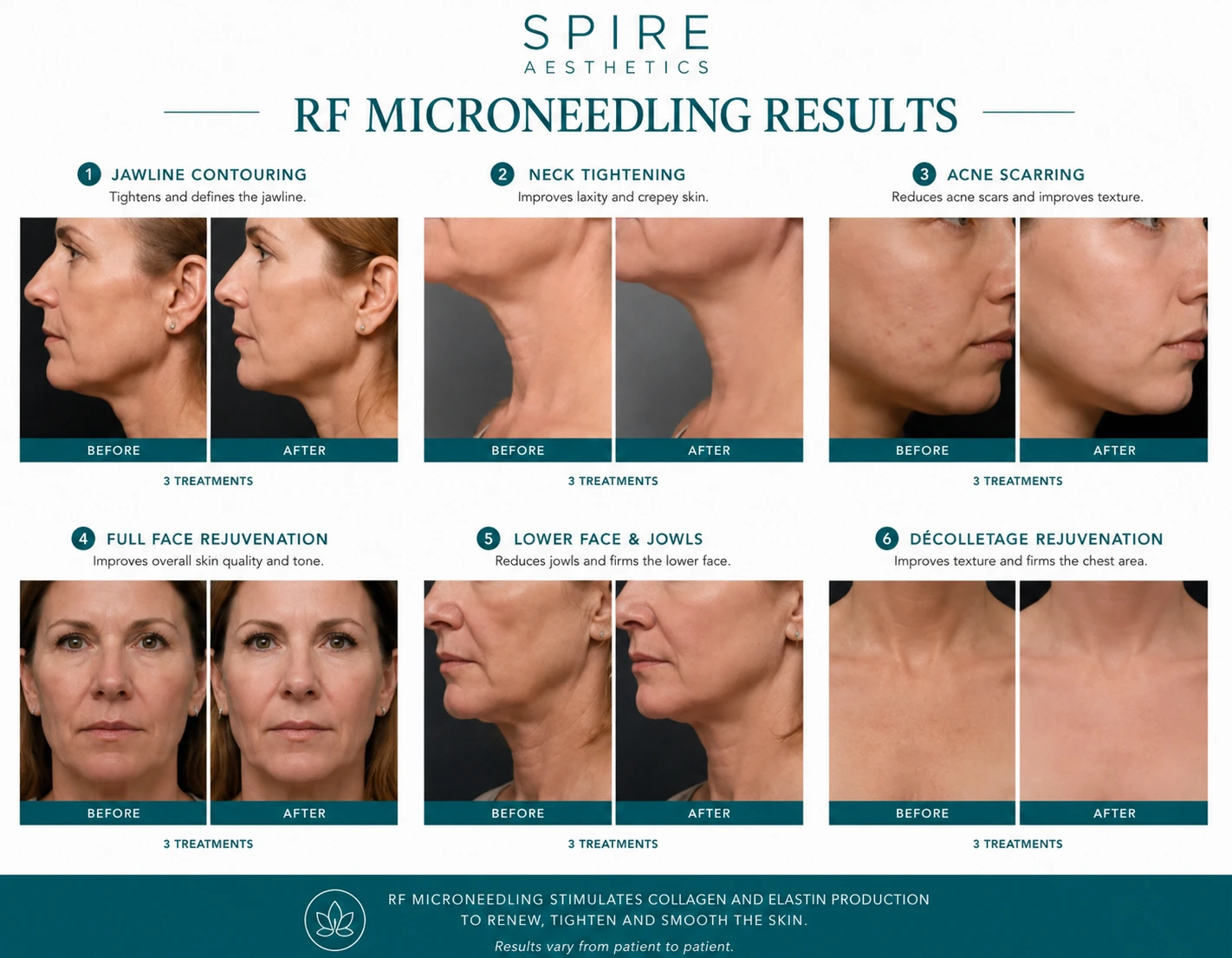 RF Microneedling Skin tightening Cannock results
