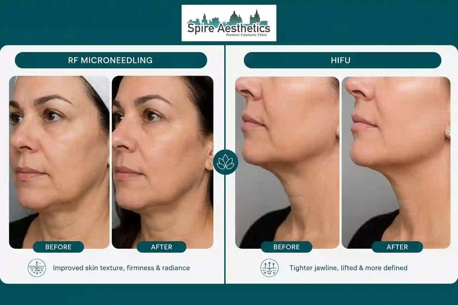 Can RF Microneedling and HIFU Be Combined Cannock?