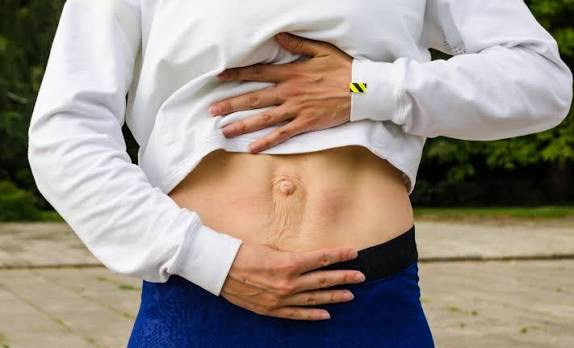 When Could Diastasis Recti Be the Missing Piece of the Puzzle Cannock?
