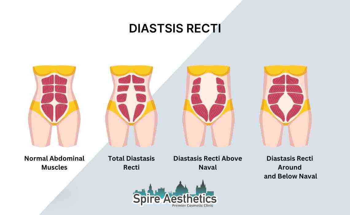 Is Non-Surgical Diastasis Recti Treatment Right for You? Common Concerns Answered Cannock